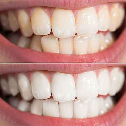 درمان-لکه-دندان