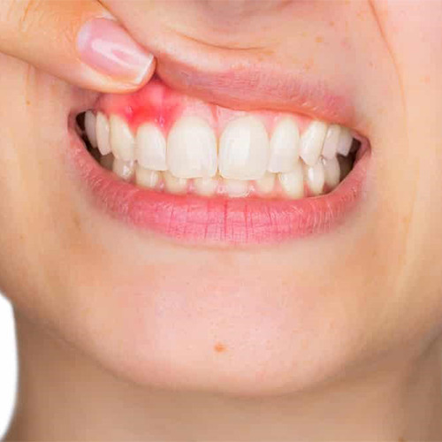 عوارض روکش دندان 