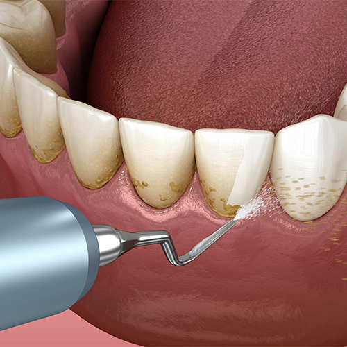 مراحل جرمگیری دندان