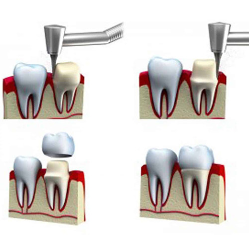 مراحل درج روکش دندان