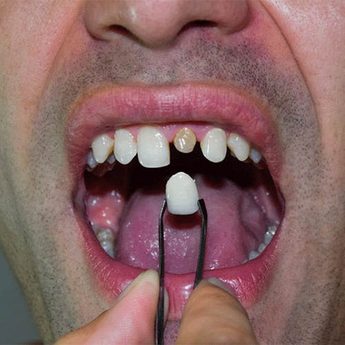 مزایا و معایب روکش دندان