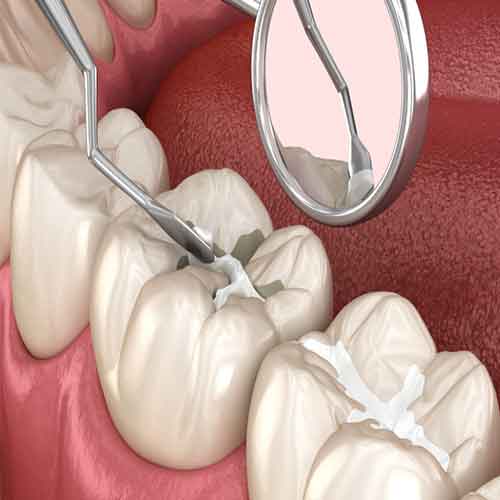 پر-کردن-دندان‌