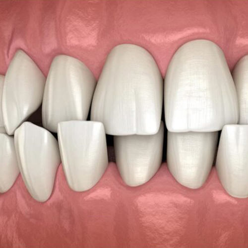 کراودینگ دندان